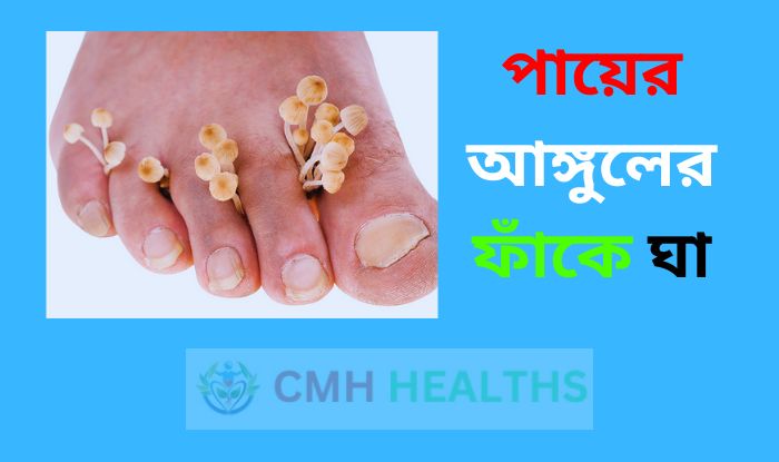 পায়ের আঙ্গুলের ফাঁকে ঘা এর ঔষধ