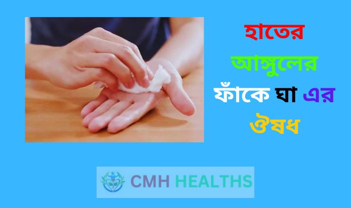 হাতের আঙ্গুলের ফাঁকে ঘা এর ঔষধ