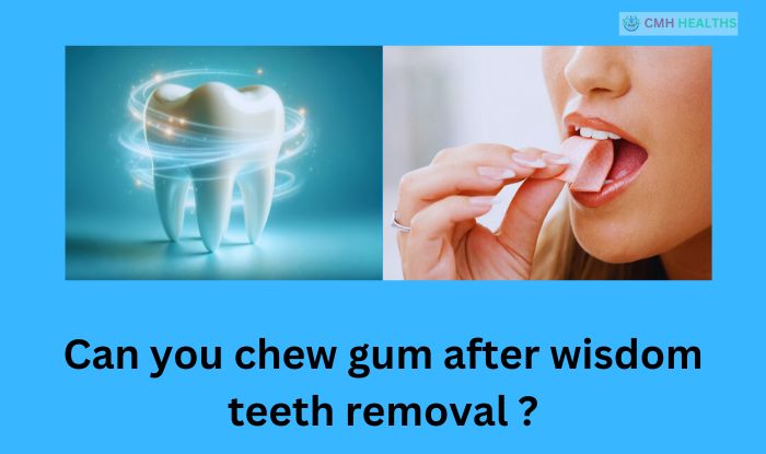 Can you chew gum after wisdom teeth removal