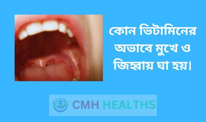 কোন ভিটামিনের অভাবে মুখে ও জিহ্বায় ঘা হয়