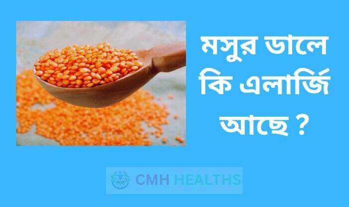 মসুর ডালে কি এলার্জি আছে
