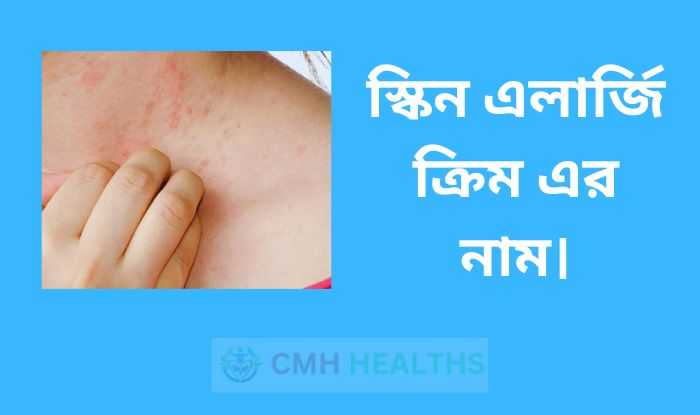 স্কিন এলার্জি ক্রিম