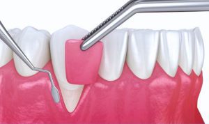 Receding gum on one tooth