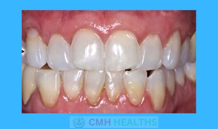 What do receding gums look like