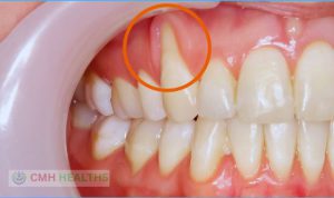 What do receding gums look like