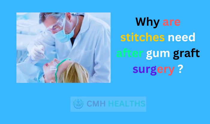 Why are stitches need after gum graft surgery